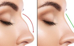 Tiêm chất làm đầy để nâng mũi, vừa kết thúc thủ thuật cô gái 19 tuổi lập tức bị mù 1 bên mắt