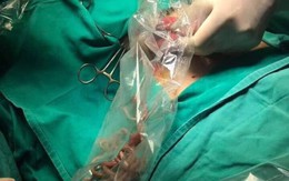 Từ vụ mổ cấp cứu lấy búi giun 100 con trong bụng bệnh nhân 11 tuổi, cha mẹ cần làm ngay những việc này kẻo sau lại hối tiếc