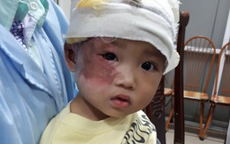 Khuôn mặt xinh xắn của cô bé dân tộc Vừ Thị Kê đang dần phục hồi sau bỏng nặng