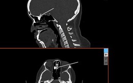 Hy hữu: bác sĩ lấy răng mọc trong... mũi bệnh nhân
