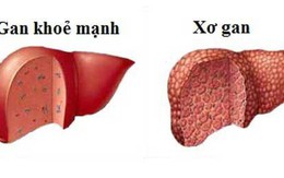 Bệnh xơ gan cần kiêng gì?