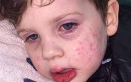 Bé trai 3 tuổi nhiễm virus bệnh tình dục sau nụ hôn vào má