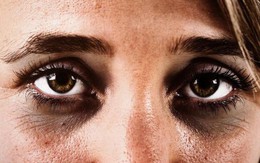 Quầng thâm dưới mắt: nguyên nhân và cách khắc phục