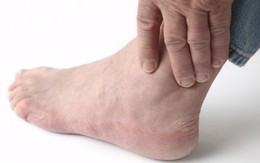 Dấu hiệu của bệnh gout