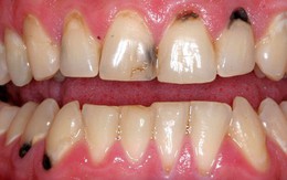 Làm thế nào để ngăn chặn tình trạng chân răng bị đen và xỉn màu?