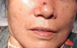 Nốt ruồi trên sống mũi bỗng "hoá" thành ung thư: Cách phân biệt nốt ruồi và ung thư