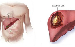 Dưỡng gan đúng hay sai đều bắt đầu từ việc ăn uống, đây là 4 việc bác sĩ rất tán thành