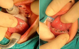 Cha mẹ bỏ bê chú ý, bé trai 4 tuổi phải nhổ toàn bộ hàm răng