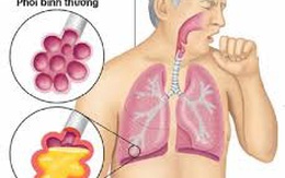 Đón Tết đừng quên phòng chống bệnh viêm phổi cấp lây truyền từ Vũ Hán, Trung Quốc