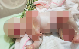 Xót xa hình ảnh bé sơ sinh mắc bệnh cực hiếm, chào đời với lớp bọc trắng cứng như sừng