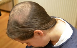 Con gái liên tục tự nhổ tóc mỗi ngày, 15 tuổi đã hói cả đầu, mẹ đưa đi khám mới tá hóa phát hiện sự thật