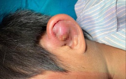 Cứu bé trai ở vùng lũ bị viêm sụn vành tai
