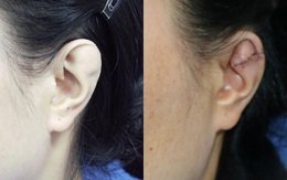 Người phụ nữ giấu chồng về đôi tai dị tật suốt 15 năm