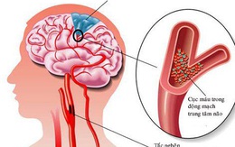 Ngày càng nhiều người trẻ bị đột tử do tắc mạch máu não: 2 món ăn cần tránh xa và 9 thực phẩm nên ăn thường xuyên để làm sạch mạch máu não