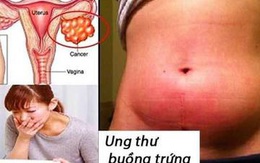 Nếu bạn có 10 dấu hiệu này, hãy nghi ngờ ung thư buồng trứng