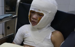 Bị bỏng xăng nặng cậu bé 8 tuổi đón Tết buồn trong bệnh viện