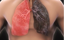 Mắc ung thư phổi sống được bao lâu?