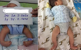 Nghệ An: Điều trị thành công bàn chân khoèo cho trẻ sơ sinh bằng phương pháp Ponseti