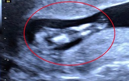 Hiếm gặp: Phát hiện một trường hợp thai nhi mắc hội chứng… người cá