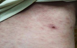 Nghệ An: Nhiều người nhập viện vì bệnh "sốt mò"