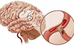 Nhận biết thiếu máu não