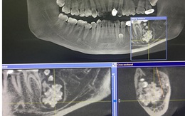 Bác sĩ gắp răng lúc nhúc trong miệng nam thanh niên Hà Nội