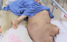 Hãi hùng khối u nặng... 42kg vừa được BV Đại học Y Hà Nội cắt bỏ