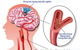 Giải pháp hỗ trợ giảm nguy cơ tai biến cho người cao huyết áp