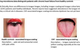 Chuyên gia cảnh báo: Đặc điểm này ở lưỡi là dấu hiệu nhận biết bệnh tim nguy hiểm