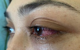 Tưởng đau mắt đỏ, bệnh nhân suýt mù vì bệnh rò động mạch màng cứng xoang hang