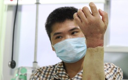 Kỳ tích bác sĩ Việt: Chuyện chưa kể về ca ghép chi đầu tiên trên thế giới từ người cho còn sống