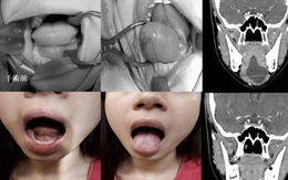 Cô gái nói chuyện không ai hiểu, đi khám phát hiện có khối u to bất thường