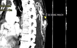 Tưởng mụn hóa búi dị dạng động tĩnh mạch