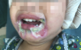 Bé gái 2 tuổi bỏng nặng vùng miệng do cắn dây điện, cảnh báo sự bất cẩn của người lớn vô tình hại trẻ