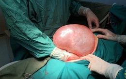 Chủ quan với bụng to nhanh, người phụ nữ giật mình khi mang khối u nặng gần 9kg