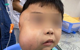 Phẫu thuật thành công bé trai bị u xơ vòm mũi họng khổng lồ