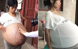 Bà mẹ kêu cứu vì bụng phình to như mang thai