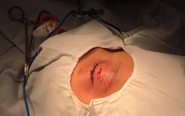 Bé trai 9 tuổi bị ghi đông xe đâm vào mắt