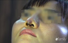 Người phụ nữ bị đứt lìa trụ mũi, chảy dịch và máu sau 12 ngày đi nâng mũi "chui"