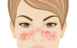 Điều trị bệnh Lupus ban đỏ