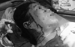 Hẹn đánh ghen, một phụ nữ bị đâm rách mặt