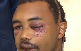 Chàng trai bị cảnh sát bắn mù mắt giữa biểu tình ở Mỹ