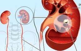 Bác sĩ khoa Thận nhắc bạn 6 điều quan trọng giúp thận khoẻ, tránh được các bệnh về thận