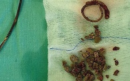 Ống thông niệu quản bỏ quên 8 năm trong cơ thể