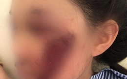 Áo chống nắng cuốn vào bánh xe khiến nữ sinh tổn thương mặt nghiêm trọng