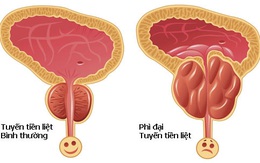 Quý ông đi tiểu nhiều coi chừng mắc căn bệnh siêu khó chịu này