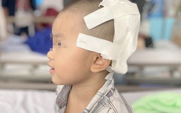 Ngã xe đạp, bé trai 2 tuổi bị lõm hộp sọ