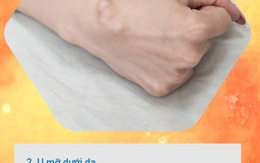 BS khuyến cáo về các loại u vùng cổ tay hay gặp: Đừng bỏ qua vì đó có thể là dấu hiệu cảnh báo bệnh nguy hiểm