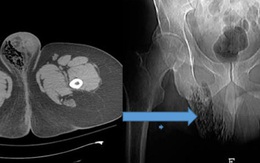 Người đàn ông nước ngoài mắc chứng hoại thư Fournier hiếm gặp