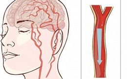 Người đàn ông 40 tuổi bị nhồi máu não, bác sĩ chỉ rõ: Ăn sáng theo 2 kiểu này thì sớm muộn mạch máu cũng bị tổn thương, tăng nguy cơ đột quỵ